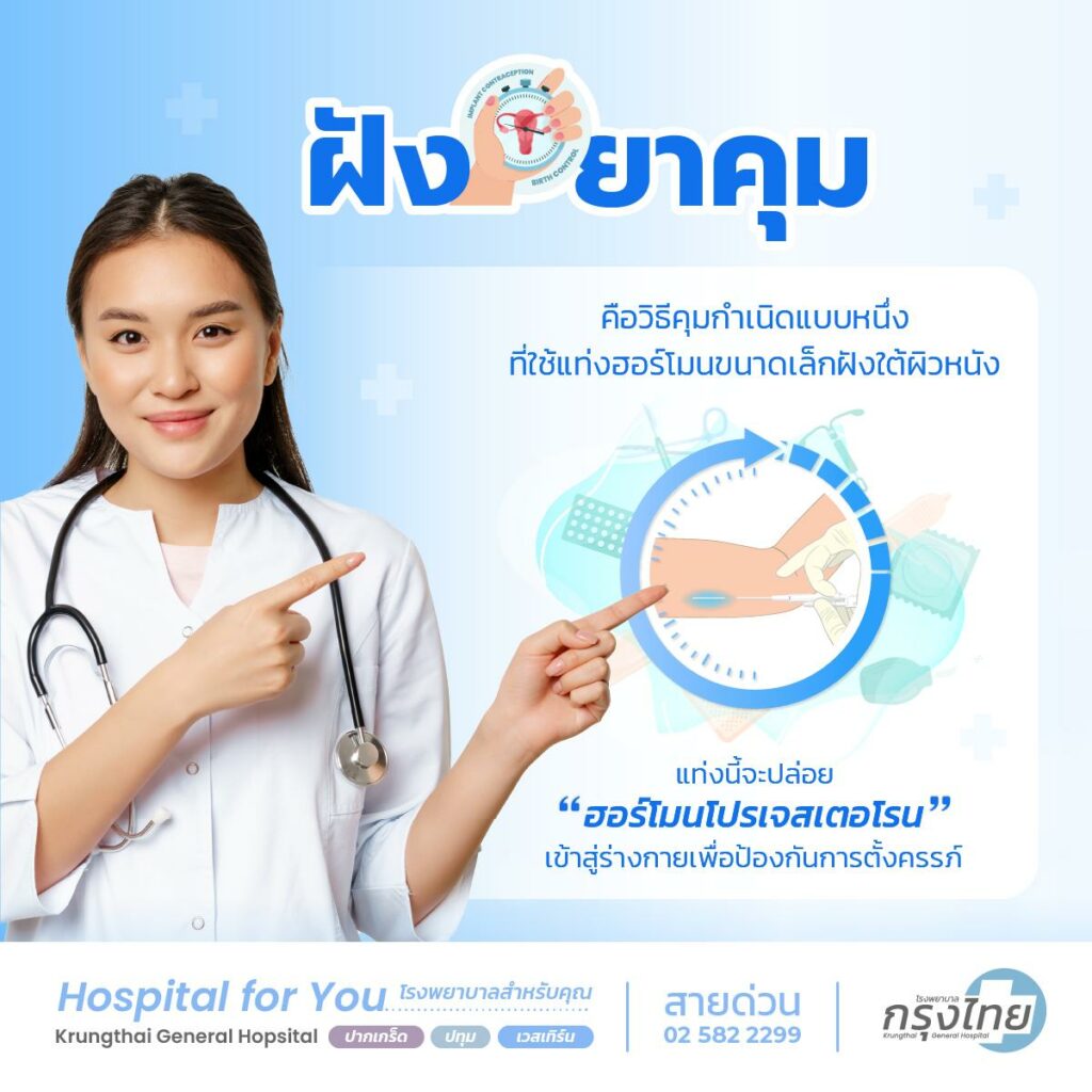 ฝังยาคุม คืออะไร